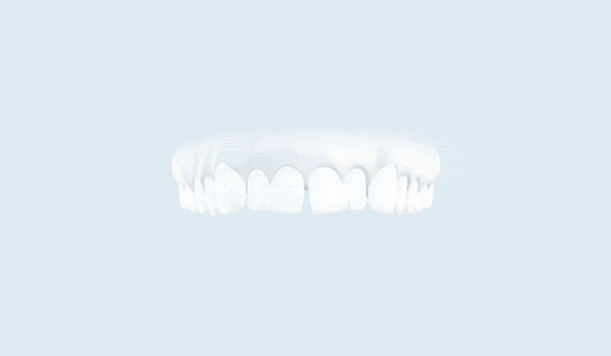 Animation - Begradigung der Zähne durch eine Zahnschiene